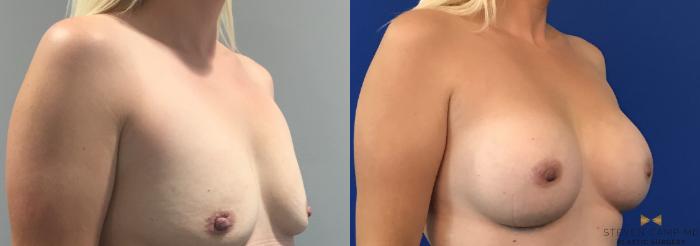 Before & After Breast Augmentation Case 109 View #4 View in Fort Worth, Texas