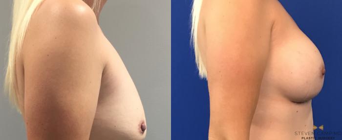 Before & After Breast Augmentation Case 109 View #5 View in Fort Worth, Texas