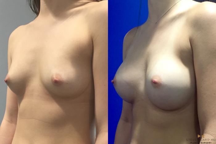 Before & After Breast Augmentation Case 113 View #1 View in Fort Worth, Texas