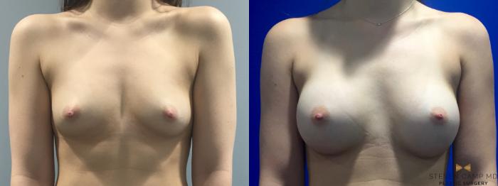 Before & After Breast Augmentation Case 113 View #2 View in Fort Worth, Texas
