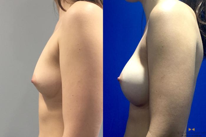 Before & After Breast Augmentation Case 113 View #3 View in Fort Worth, Texas