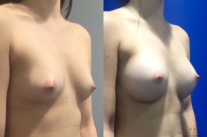 Before & After Breast Augmentation Case 113 View #4 View in Fort Worth, Texas