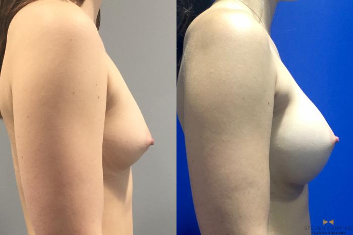 Before & After Breast Augmentation Case 113 View #5 View in Fort Worth, Texas