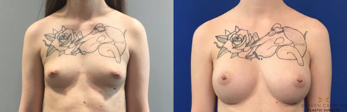 Before & After Breast Augmentation Case 114 View #1 View in Fort Worth & Arlington, Texas