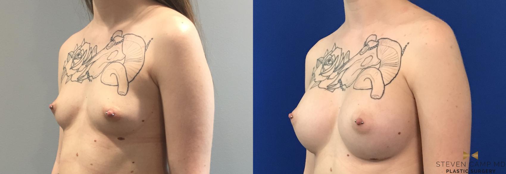 Before & After Breast Augmentation Case 114 View #2 View in Fort Worth, Texas