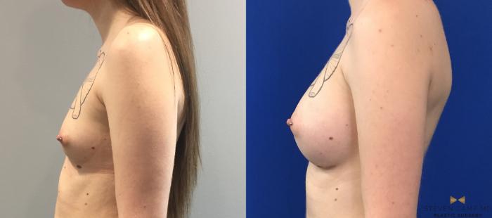 Before & After Breast Augmentation Case 114 View #3 View in Fort Worth & Arlington, Texas