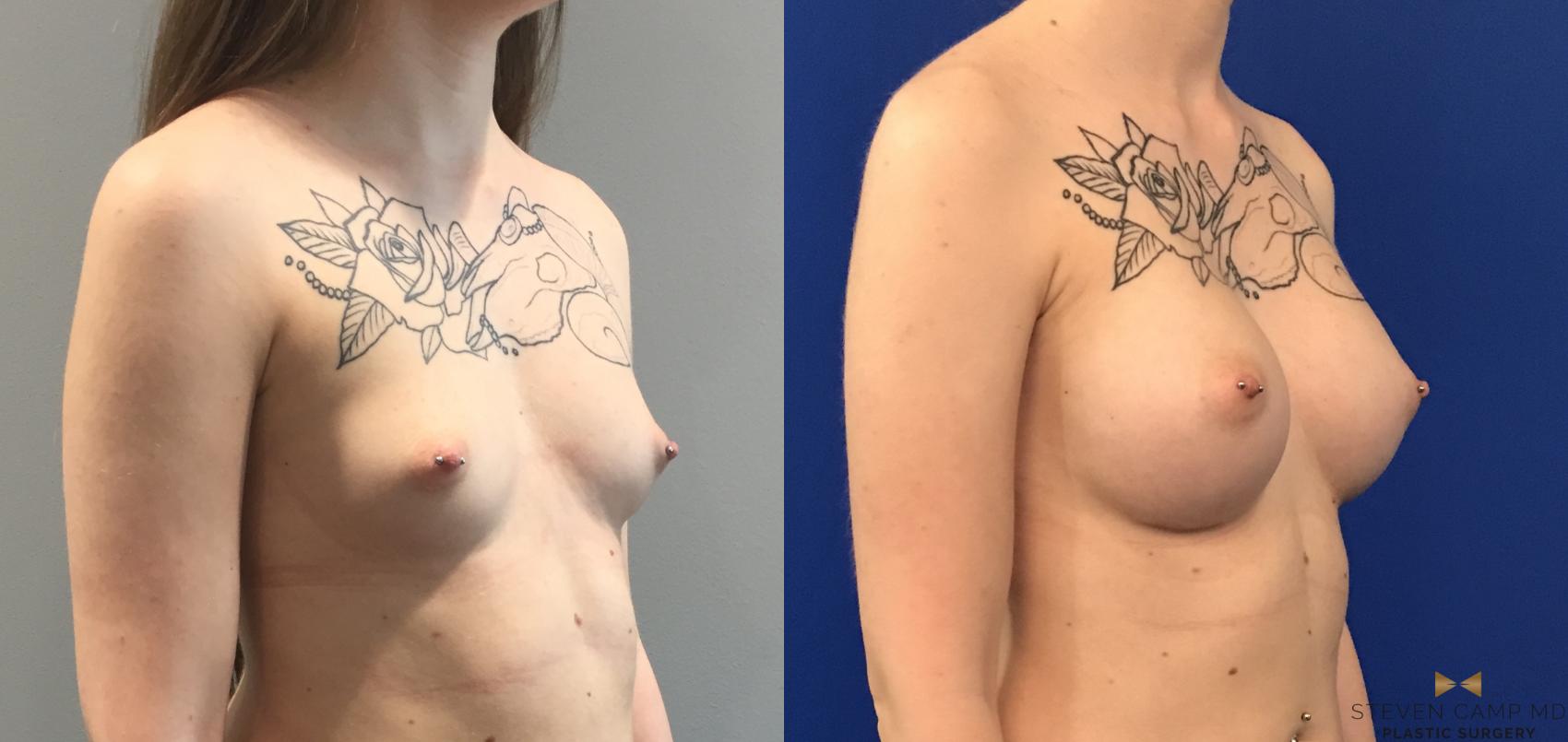 Before & After Breast Augmentation Case 114 View #4 View in Fort Worth, Texas