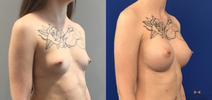 Before & After Breast Augmentation Case 114 View #4 View in Fort Worth & Arlington, Texas