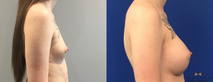 Before & After Breast Augmentation Case 114 View #5 View in Fort Worth & Arlington, Texas