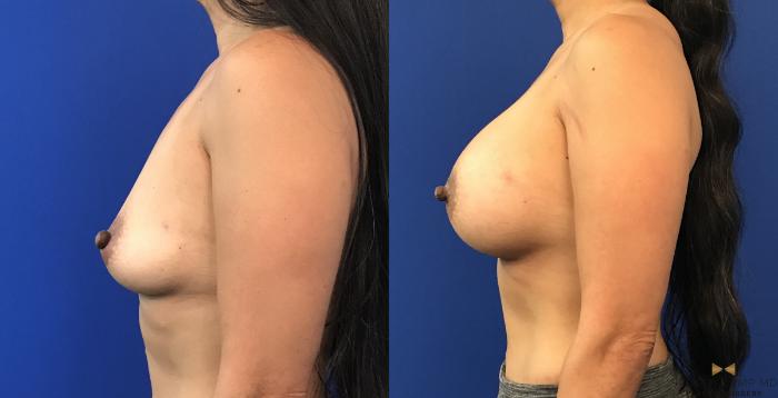 Before & After Breast Augmentation Case 117 View #1 View in Fort Worth, Texas