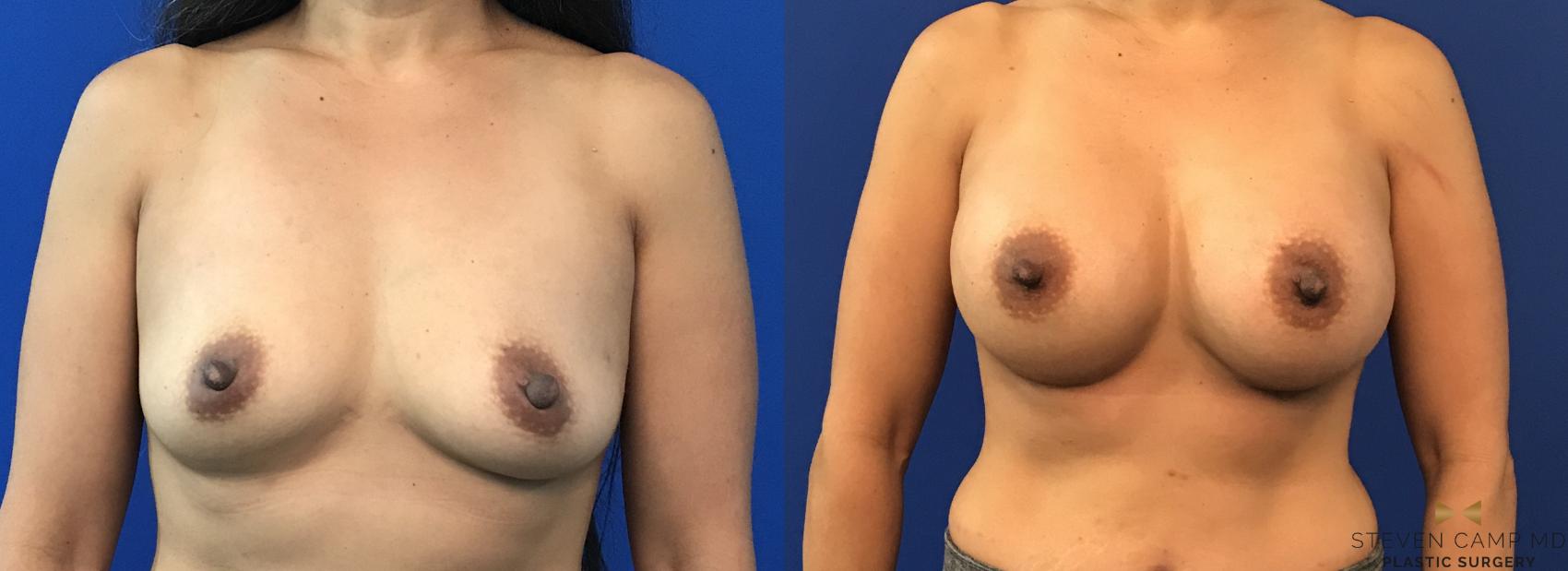Before & After Breast Augmentation Case 117 View #2 View in Fort Worth, Texas