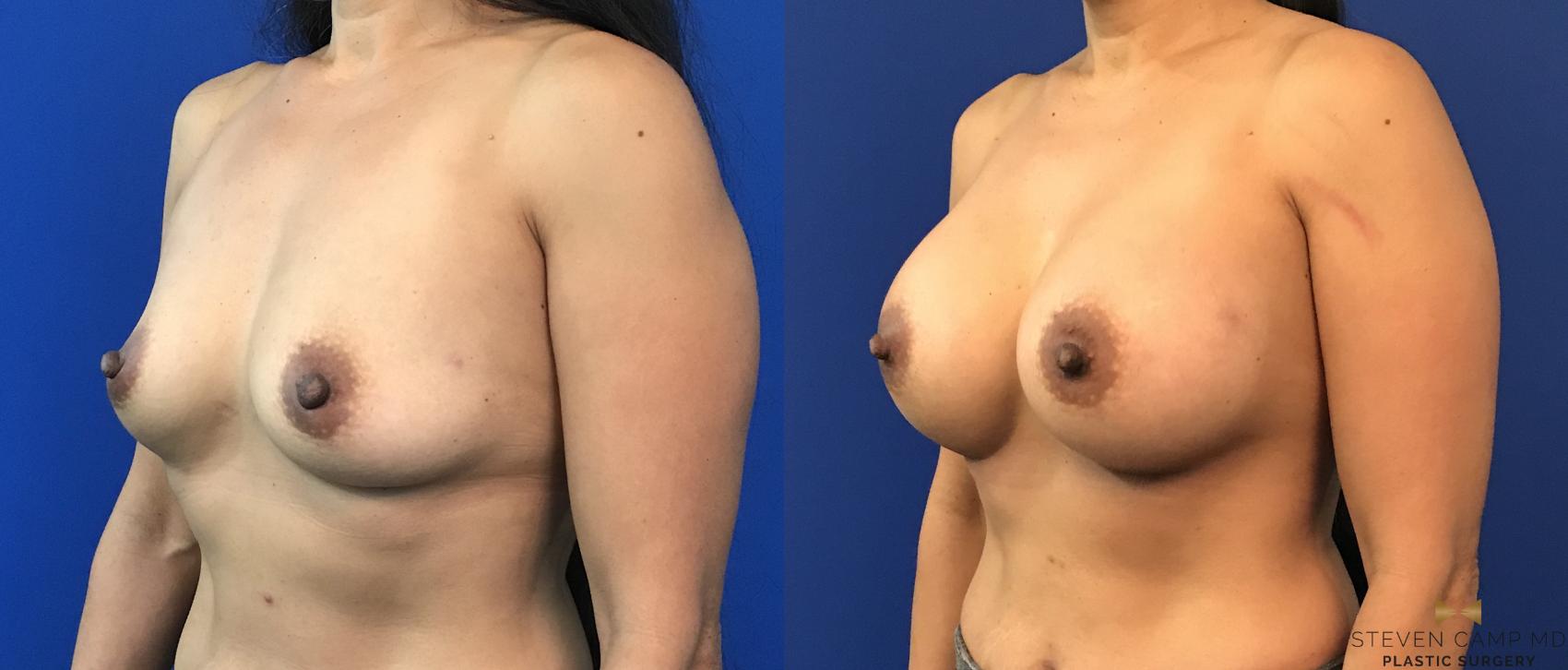 Before & After Breast Augmentation Case 117 View #3 View in Fort Worth, Texas