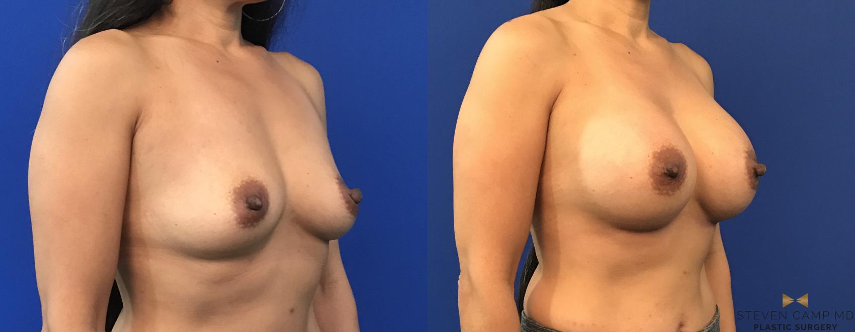 Before & After Breast Augmentation Case 117 View #4 View in Fort Worth, Texas