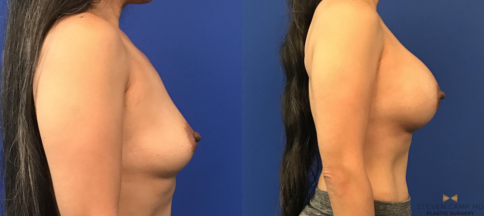 Before & After Breast Augmentation Case 117 View #5 View in Fort Worth, Texas