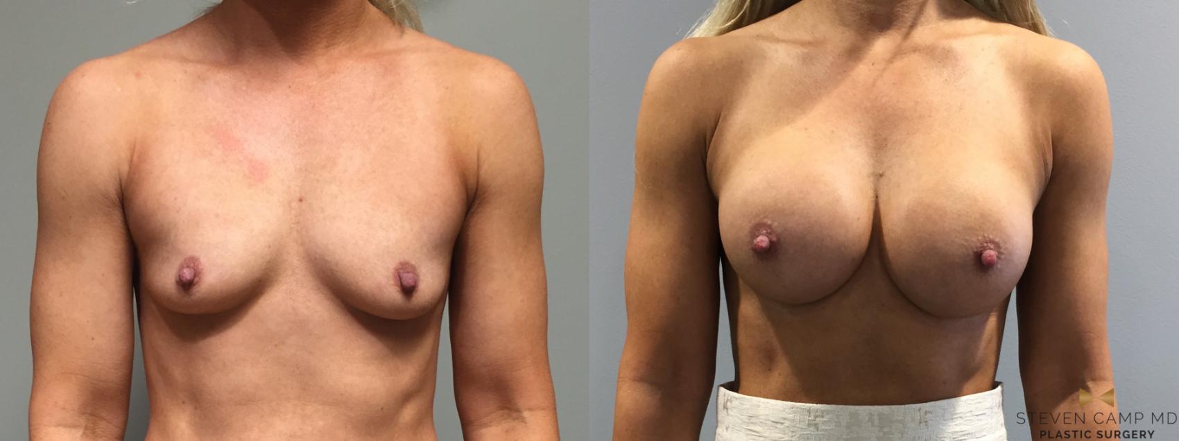 Before & After Breast Augmentation Case 118 View #1 View in Fort Worth, Texas