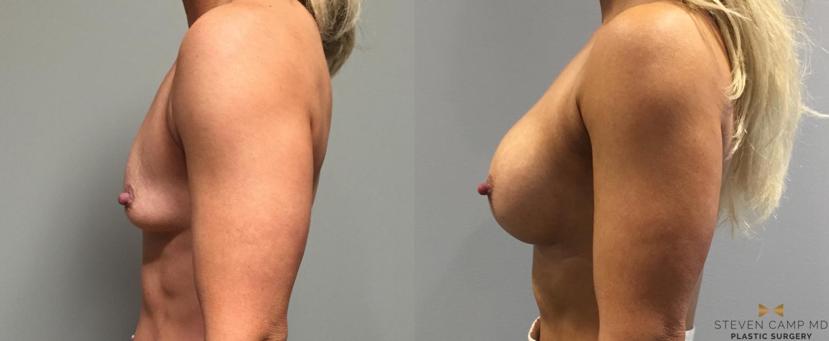 Before & After Breast Augmentation Case 118 View #2 View in Fort Worth, Texas