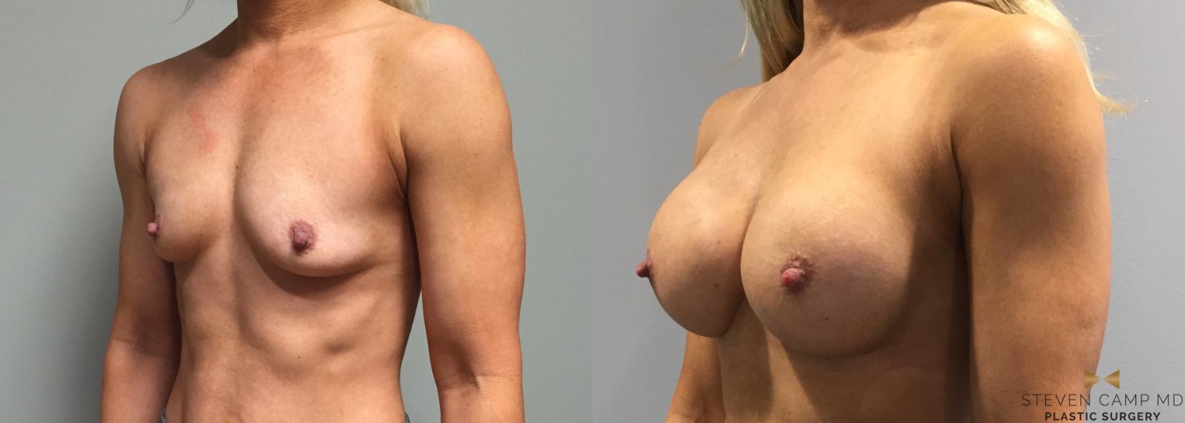Before & After Breast Augmentation Case 118 View #3 View in Fort Worth, Texas