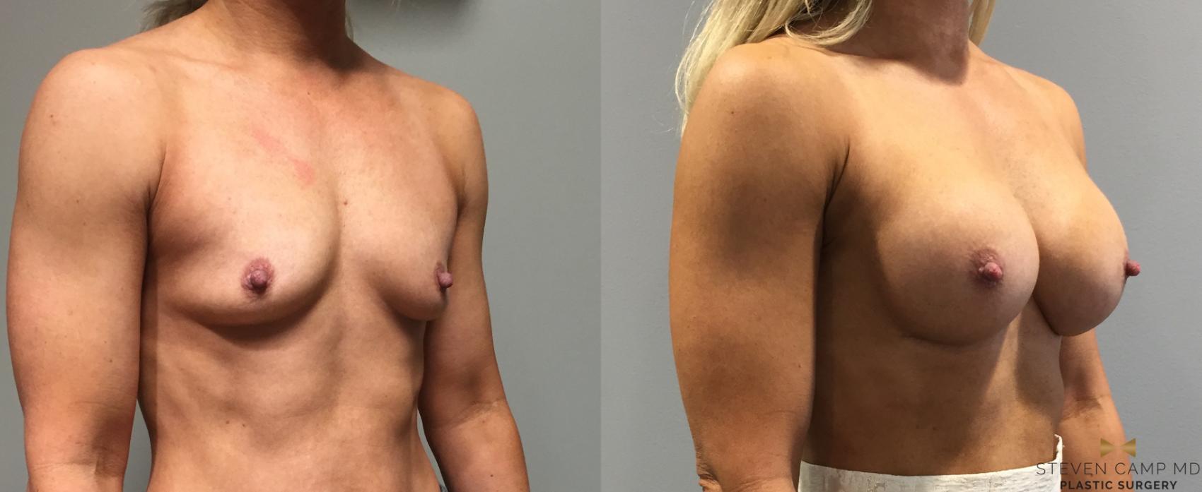 Before & After Breast Augmentation Case 118 View #4 View in Fort Worth, Texas