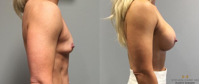 Before & After Breast Augmentation Case 118 View #5 View in Fort Worth, Texas