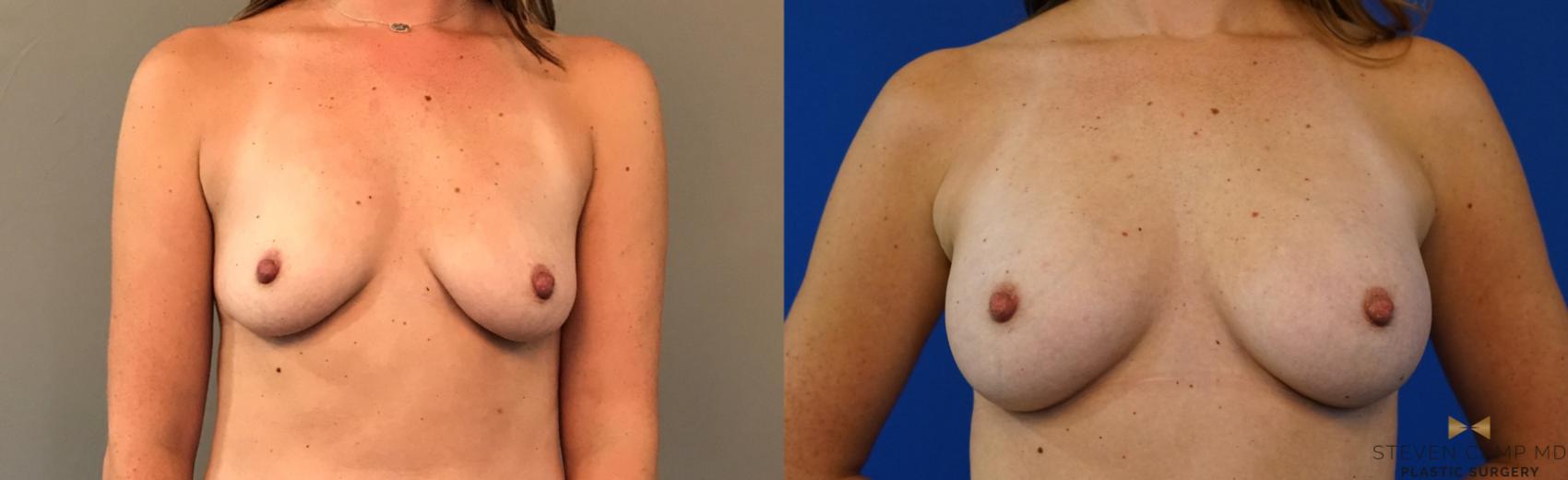 Before & After Breast Augmentation Case 124 View #1 View in Fort Worth, Texas