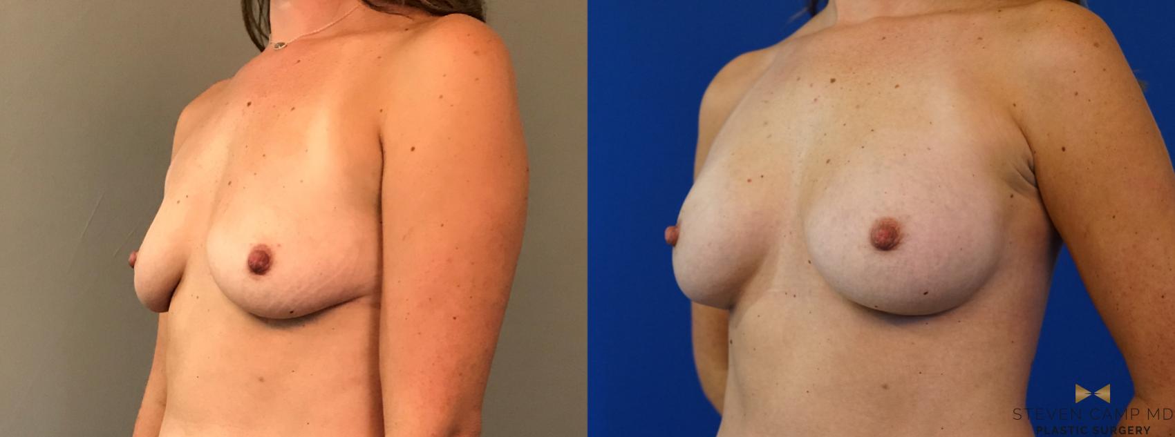 Before & After Breast Augmentation Case 124 View #2 View in Fort Worth, Texas