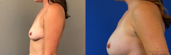 Before & After Breast Augmentation Case 124 View #3 View in Fort Worth, Texas