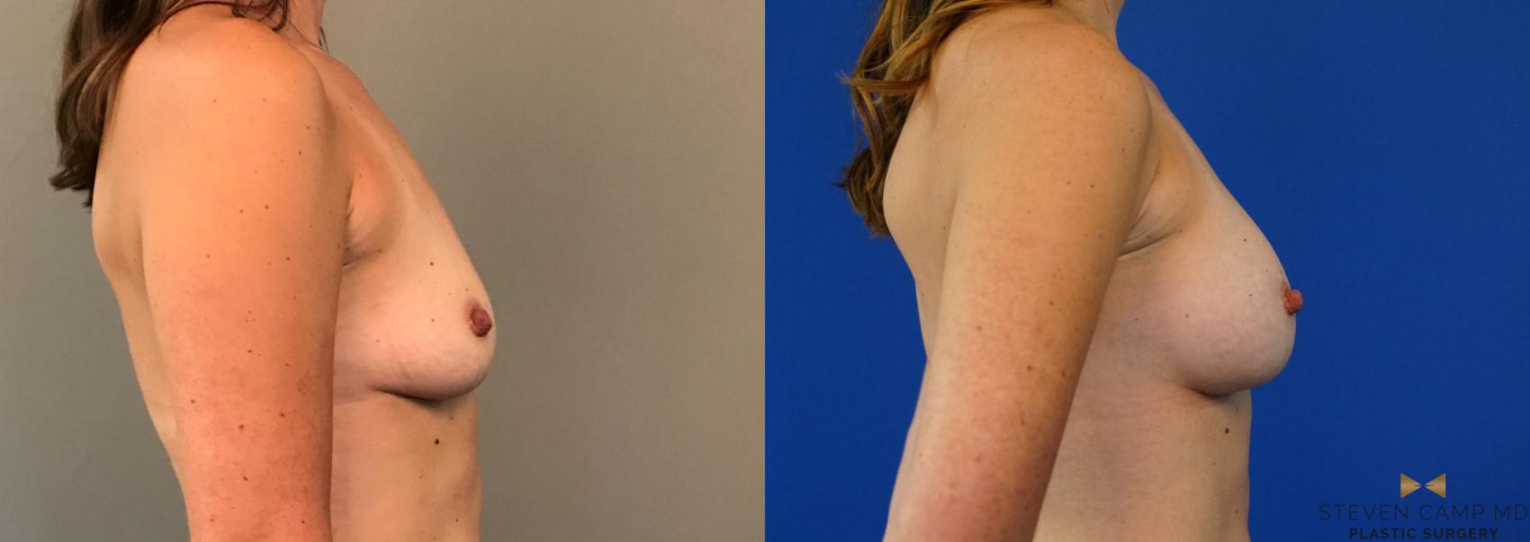 Breast Augmentation Before & After Photo | Fort Worth, Texas | Steven Camp MD Plastic Surgery