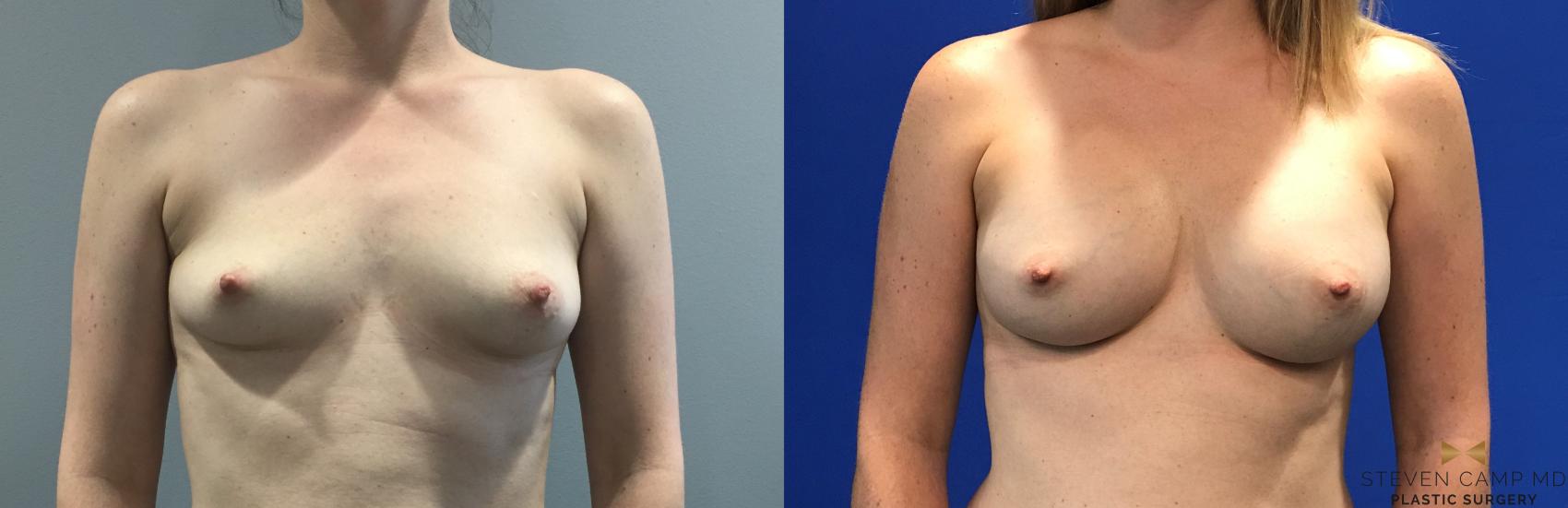 Before & After Breast Augmentation Case 133 View #1 View in Fort Worth, Texas
