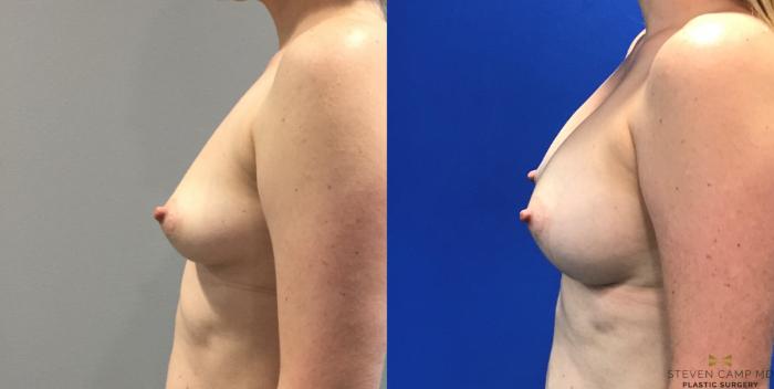 Before & After Breast Augmentation Case 133 View #3 View in Fort Worth, Texas