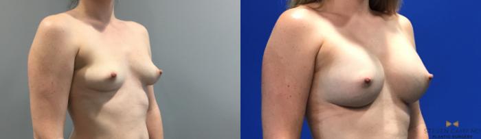 Before & After Breast Augmentation Case 133 View #4 View in Fort Worth, Texas