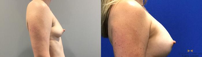 Before & After Breast Augmentation Case 133 View #5 View in Fort Worth, Texas