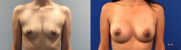 Before & After Breast Augmentation Case 136 View #1 View in Fort Worth, Texas