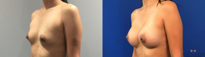 Before & After Breast Augmentation Case 136 View #2 View in Fort Worth, Texas