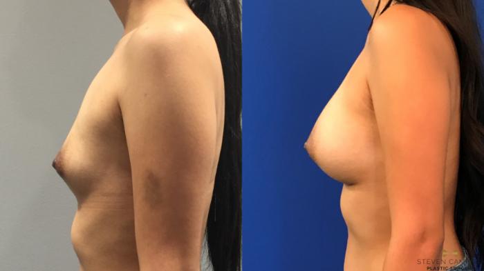 Before & After Breast Augmentation Case 136 View #3 View in Fort Worth & Arlington, Texas
