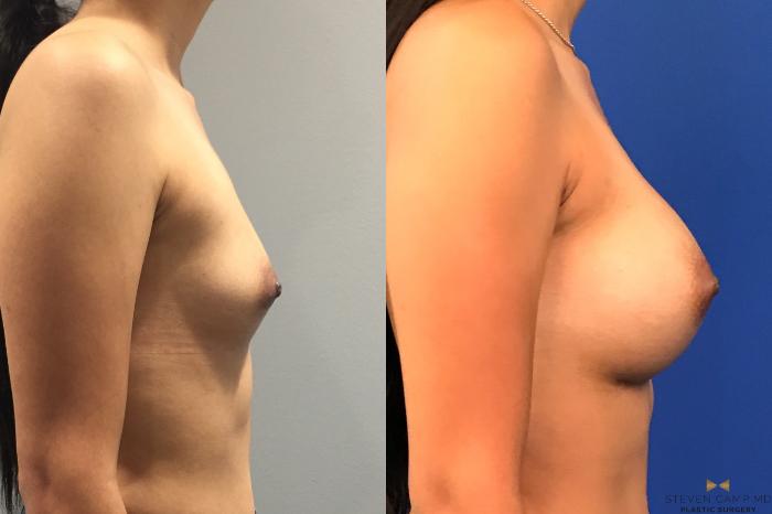 Before & After Breast Augmentation Case 136 View #5 View in Fort Worth & Arlington, Texas