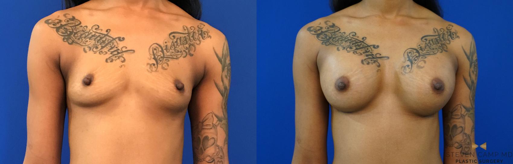 Before & After Case2997 by Steven Camp MD Plastic Surgery & Aesthetics, in Fort Worth