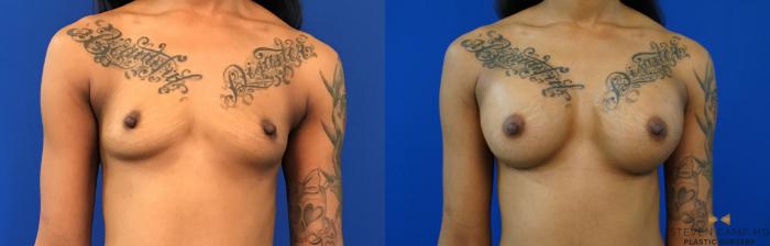 Before & After Breast Augmentation Case 140 View #1 View in Fort Worth, Texas