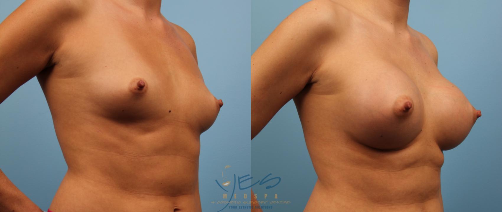 Before & After Breast Augmentation Case 140 View #2 View in Fort Worth & Arlington, Texas