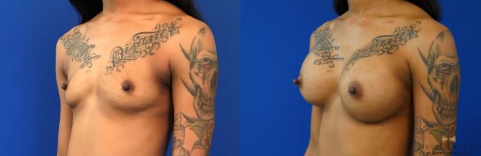 Before & After Breast Augmentation Case 140 View #2 View in Fort Worth, Texas