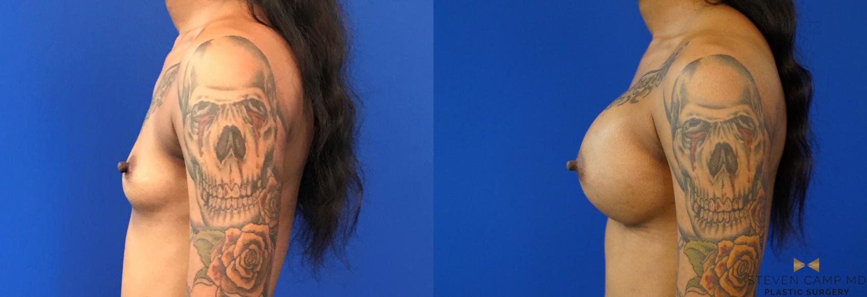 Before & After Breast Augmentation Case 140 View #3 View in Fort Worth & Arlington, Texas
