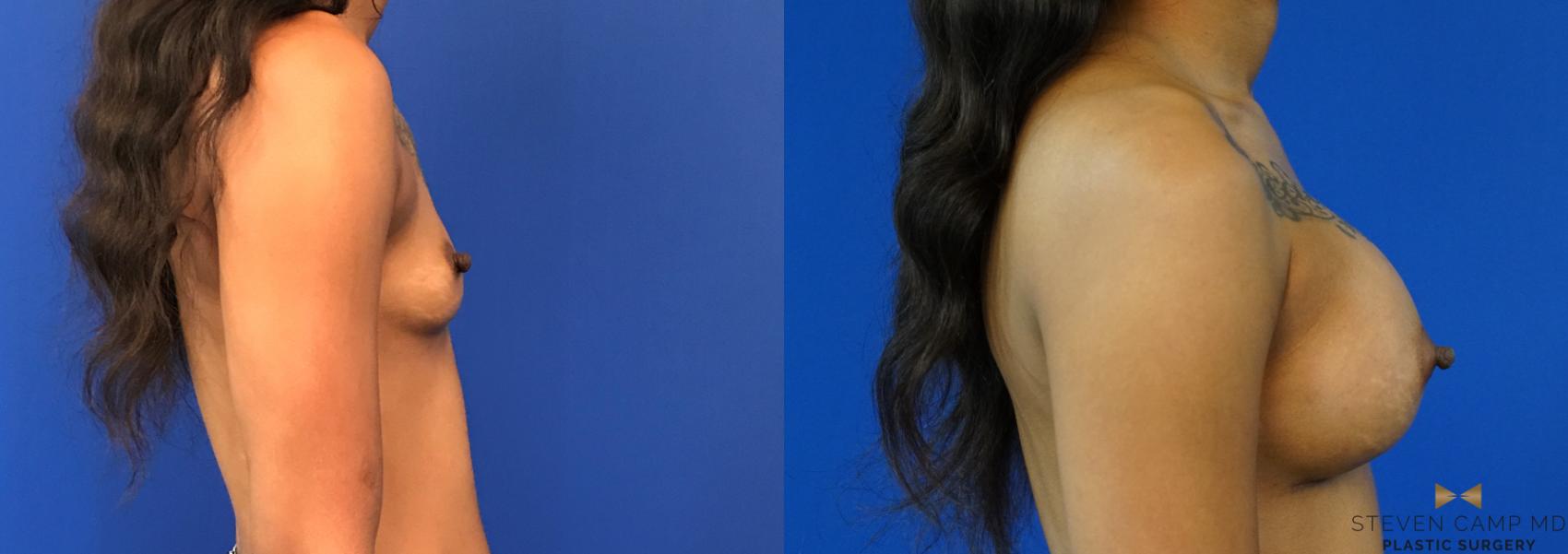 Before & After Breast Augmentation Case 140 View #5 View in Fort Worth & Arlington, Texas