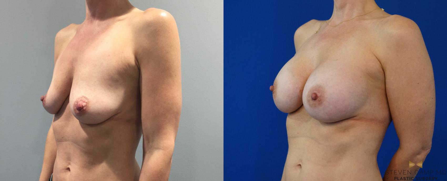 Before & After Breast Augmentation Case 143 View #1 View in Fort Worth, Texas