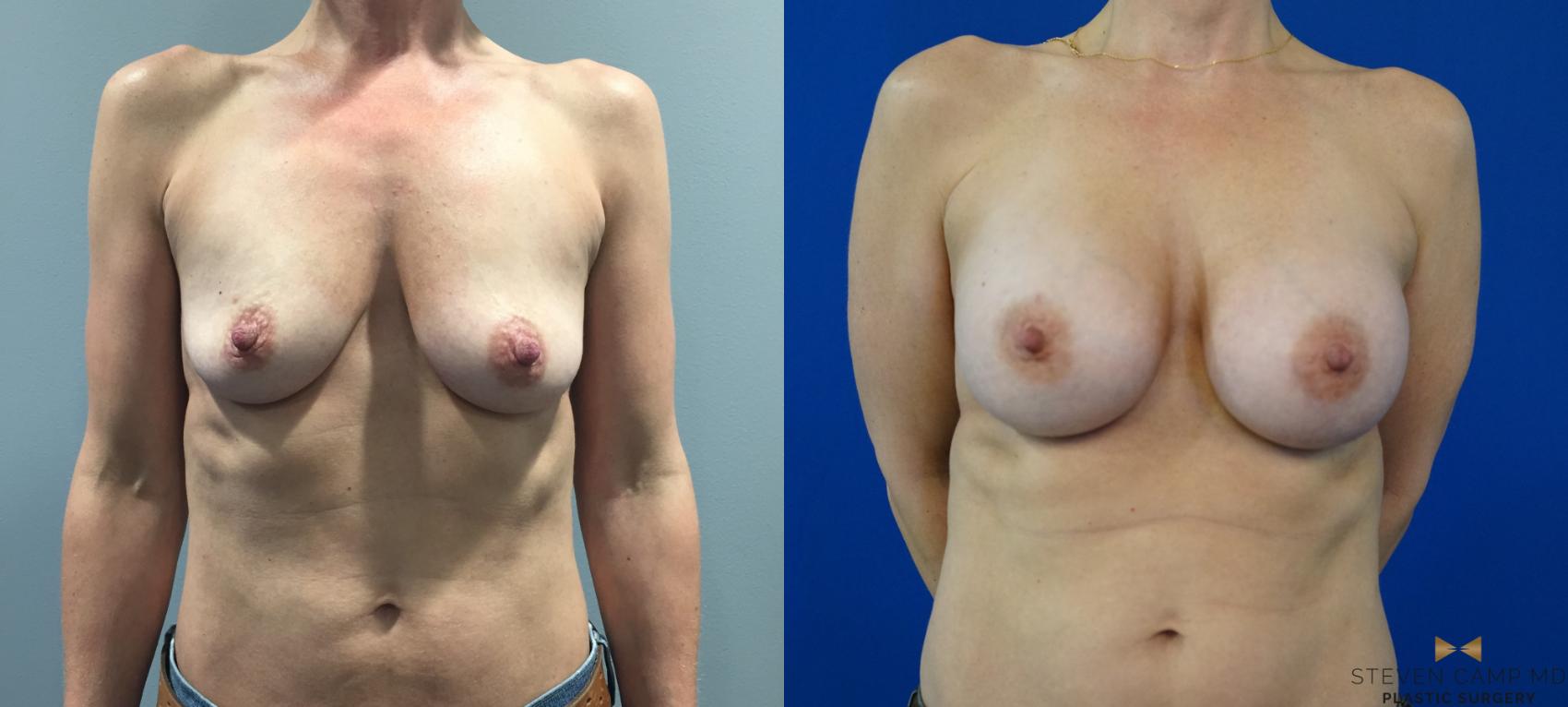 Before & After Breast Augmentation Case 143 View #2 View in Fort Worth & Arlington, Texas