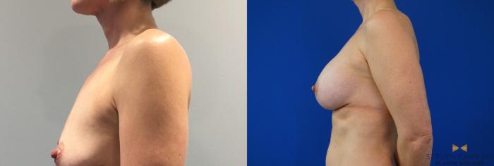 Before & After Breast Augmentation Case 143 View #3 View in Fort Worth, Texas