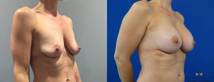Before & After Breast Augmentation Case 143 View #4 View in Fort Worth, Texas