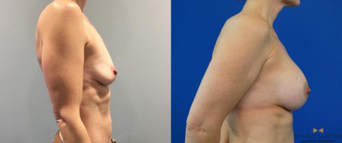 Before & After Breast Augmentation Case 143 View #5 View in Fort Worth & Arlington, Texas