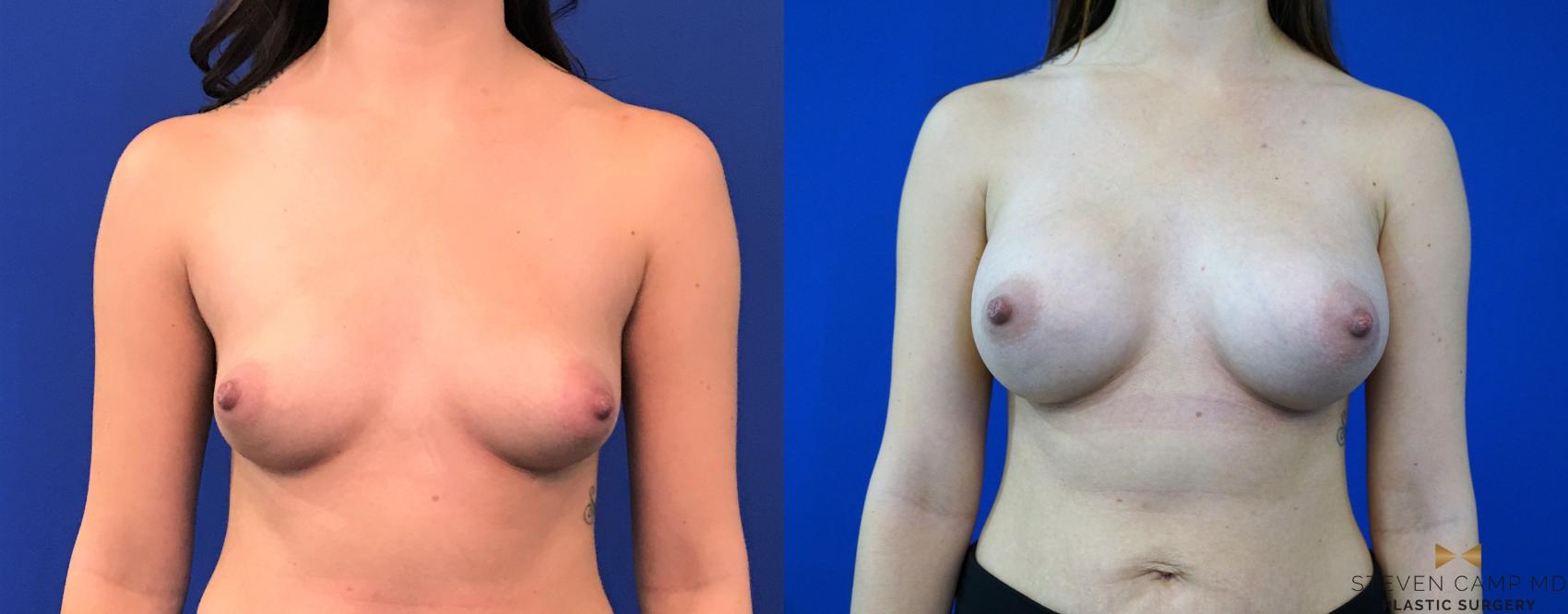Before & After Breast Augmentation Case 147 View #1 View in Fort Worth, Texas