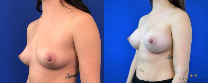 Before & After Breast Augmentation Case 147 View #2 View in Fort Worth & Arlington, Texas