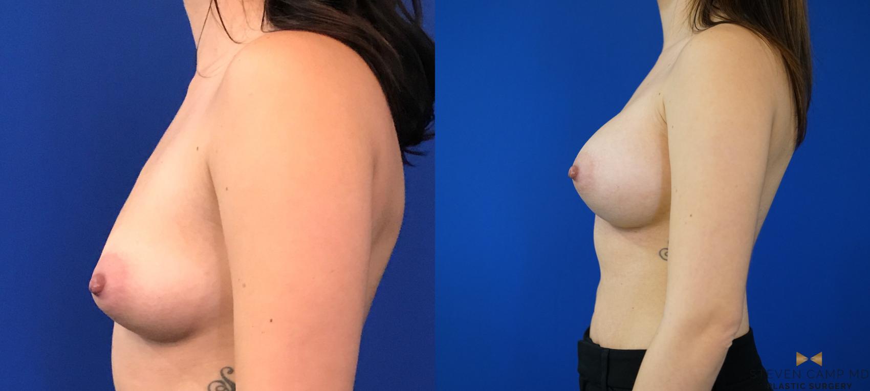 Before & After Breast Augmentation Case 147 View #3 View in Fort Worth & Arlington, Texas