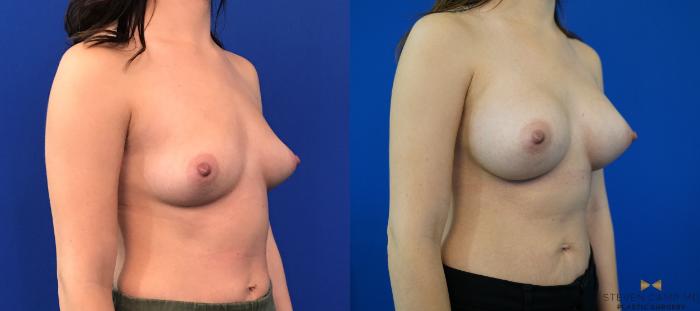 Before & After Breast Augmentation Case 147 View #4 View in Fort Worth & Arlington, Texas